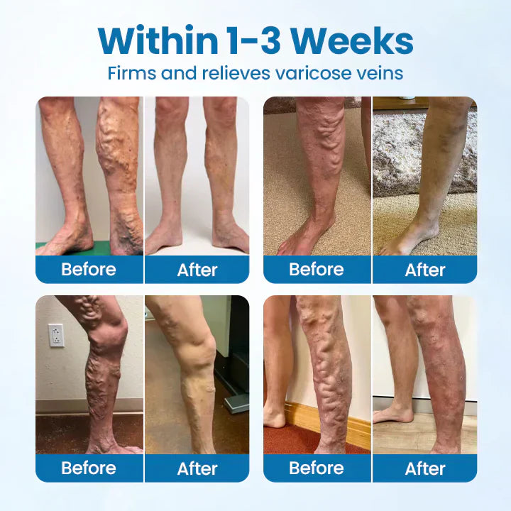 LOVILDS® VeinGuard Varicose Veins Solution Spray