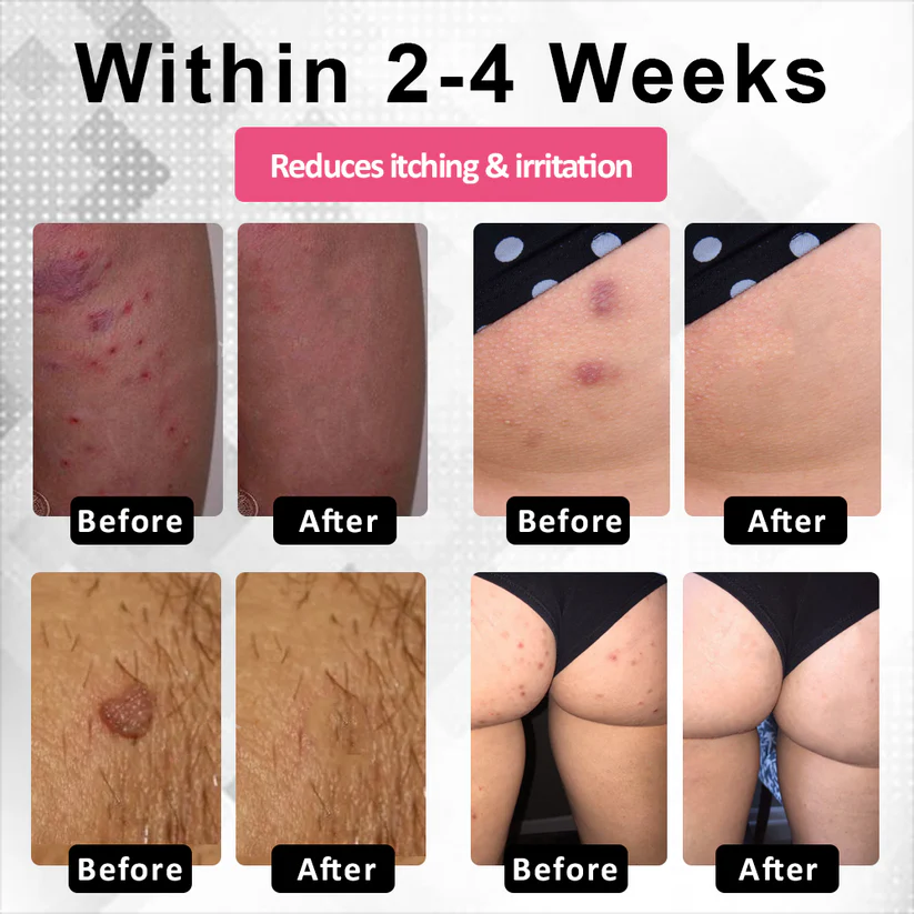 🔥 Special Deal: 60% OFF 🌸 LOVILDS® Woman's Genital HPV Healing Cream 🌸