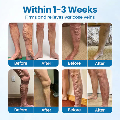 LOVILDS® VeinGuard Varicose Veins Solution Spray