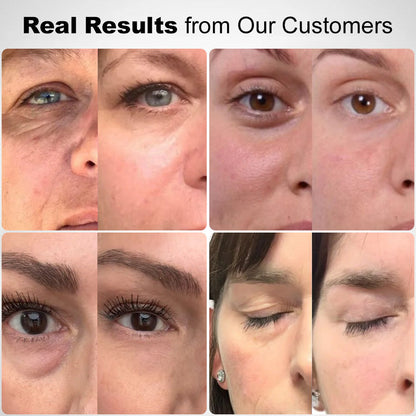 🧑‍⚕️⏳LOVILDS® Deep Precision Age-Defying Nano Microneedle Patches– Deep-Acting Solution to Say Goodbye to under-eye bags, dark circles, wrinkles, and fine lines.